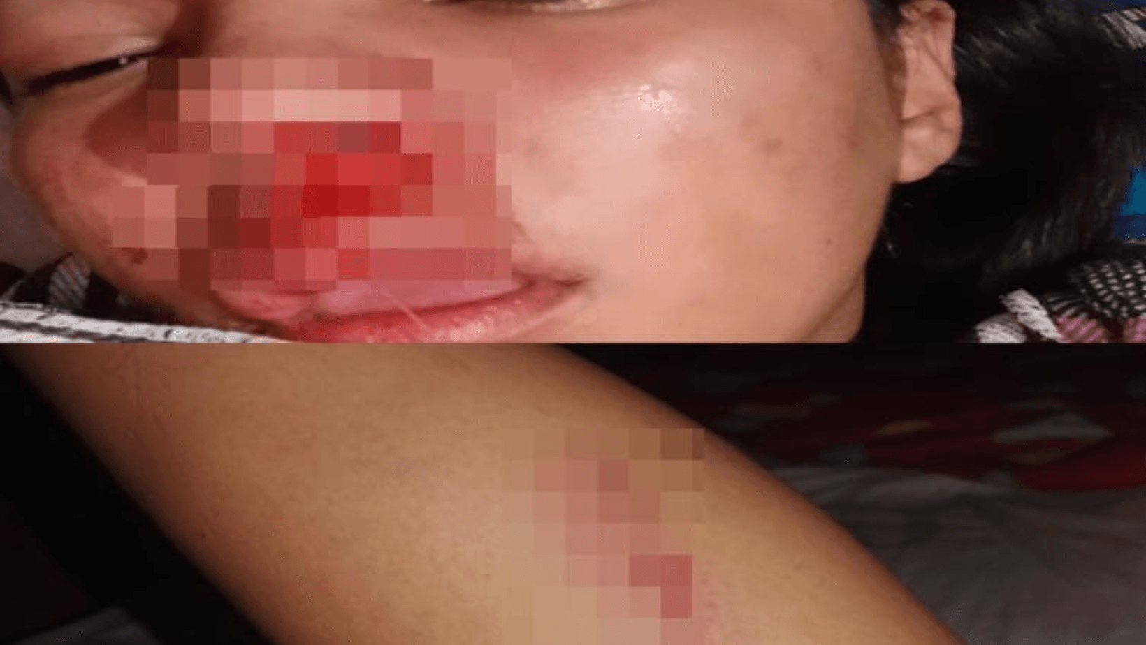 Mujer sufre brutal agresión por su compañero sentimental en Valle de San Juan